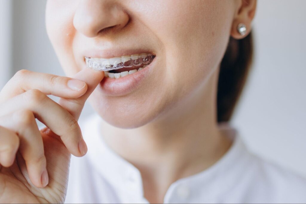 Top Reasons Why New Braunfels Adults Are Choosing Clear Aligners