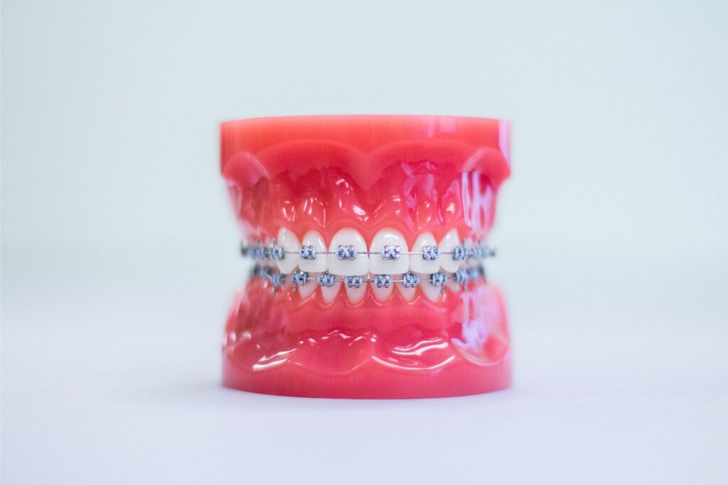 metal braces marion
